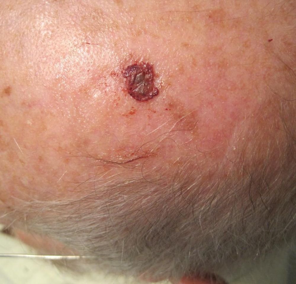 Perrin's Blend Ointment 1oz Skin Cancer Photo 2.jpg