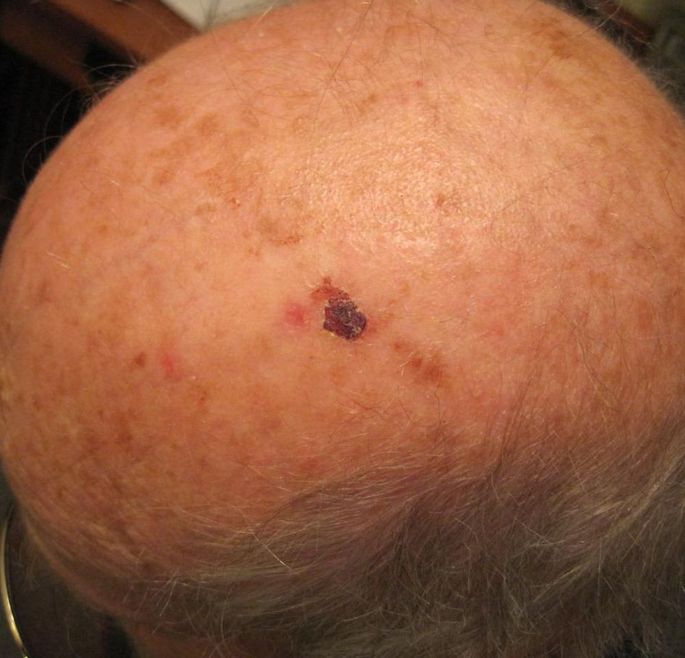 Perrin's Blend Ointment 1oz Skin Cancer Photo 3.jpg