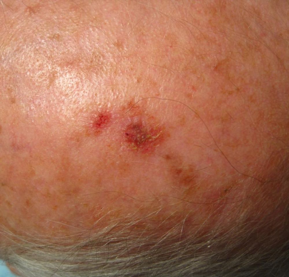 Perrin's Blend Ointment 1oz Skin Cancer Photo 4.jpg